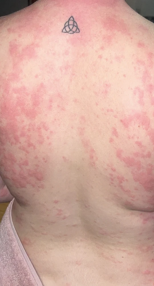 Skin Hives